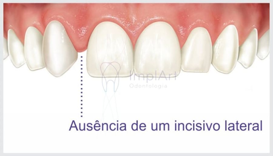 agenesia dental 91dac421