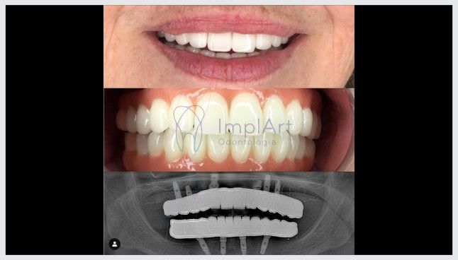 protese total zirconia translucida monolitica 40kb 91d02343