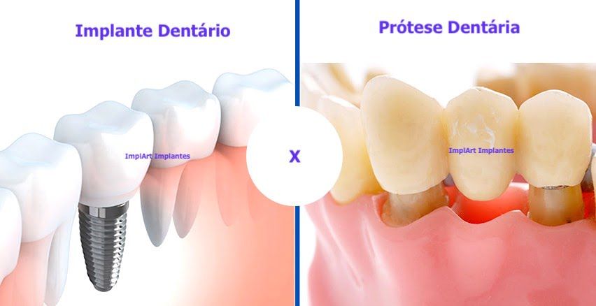 implante ou prótese dentária qual é melhor