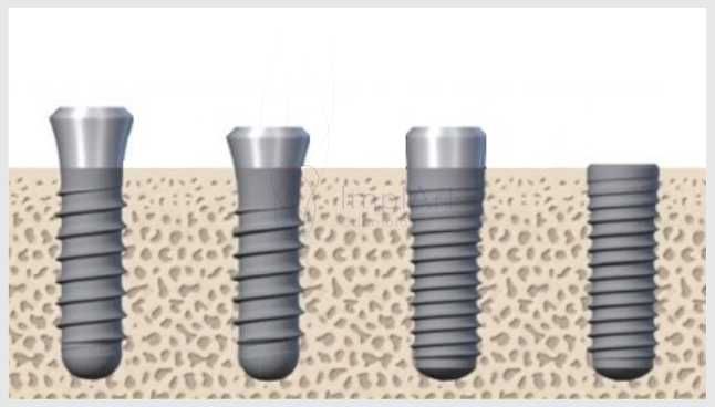 implante dentario