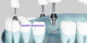 implante de tres dentes separados