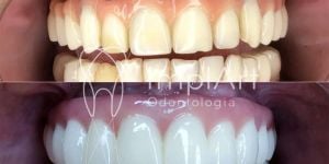 protese total fixa em zirconia implante antes e depois 50kb a6a154ae