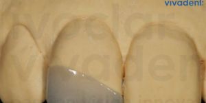 fragmento ceramico lente dental 50kb ac69a16e