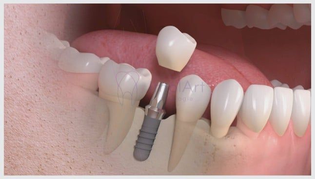 implante dentario unitario individual