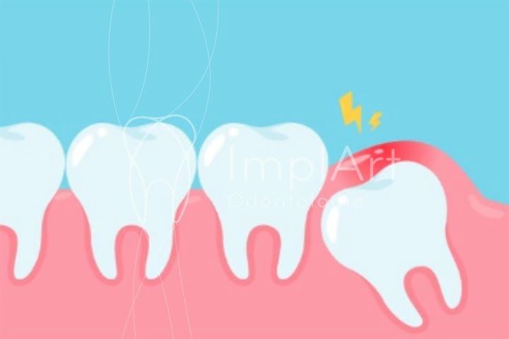 Dente siso doendo 50kb aea46e13