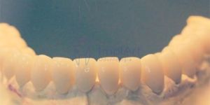 implante total dentes individualizados 50kb bb2489b3