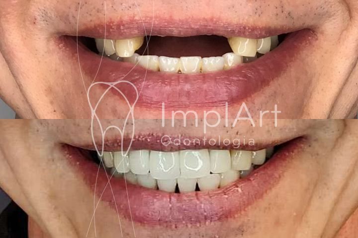 Implante dentario de 4 dentes na frente 50kb bdb1c145