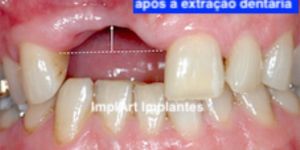 perda ossea dentaria defeito gengiva 50kb bd194933