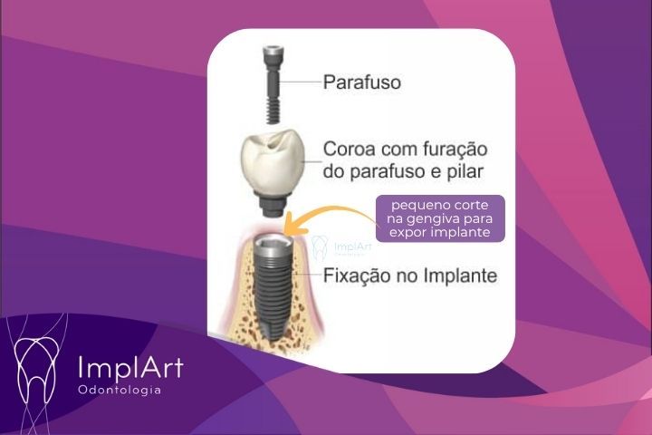 reabertura do implante dentario