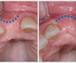 enxerto osseo antes e depois 41kb c02b9448