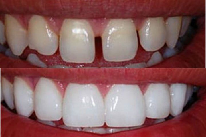 lente contato dental diastema 50kb c458f0f2