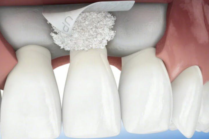 enxerto osseo dentario 50kb c7623c10