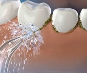 waterpik e irrigador dental