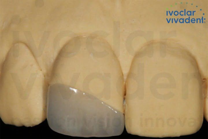 fragmento ceramico lente dental 50kb d99d7eba