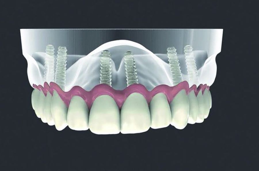 all on six seis implantes dentários