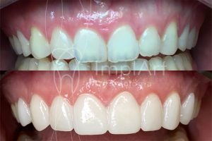 Antes E Depois Lentes Contato Dentais Gengivectomia Kb Implantes Dent Rios E Est Tica Dental