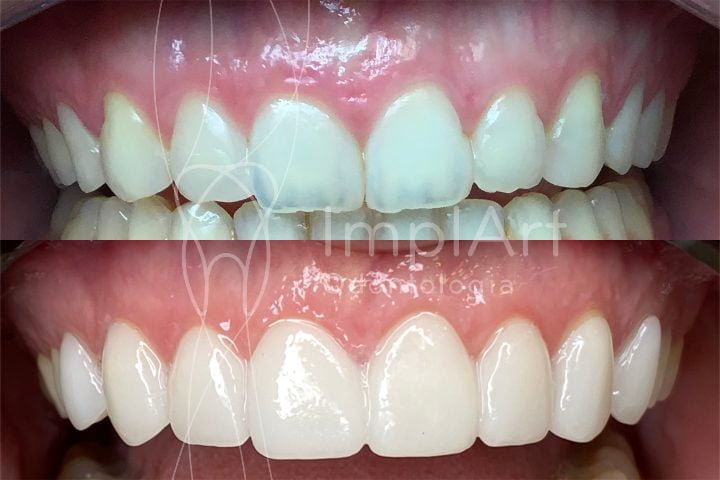 antes e depois lentes contato dentais gengivectomia 50kb