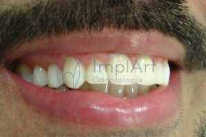 carga imediata implante rapido dente unitario 50kb