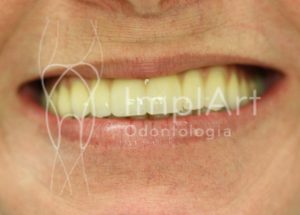 carga_imediata_para_implante_dentario