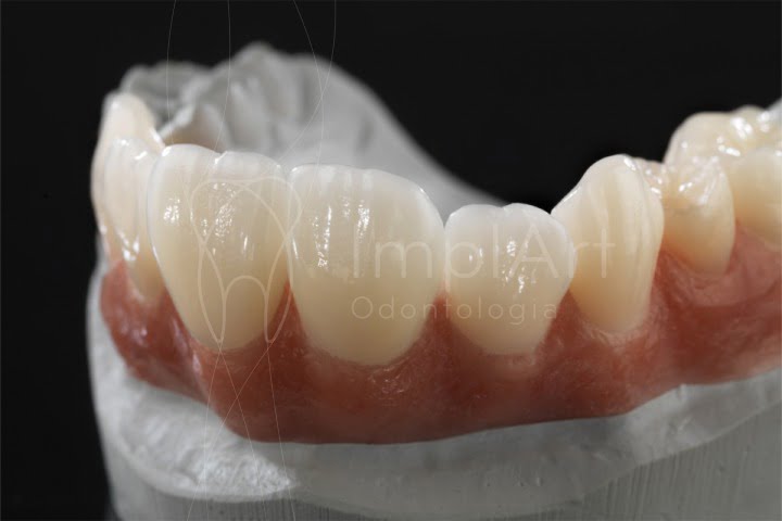 dentes de zirconia para implante dentario