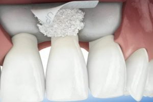 enxerto osseo dentario 50kb