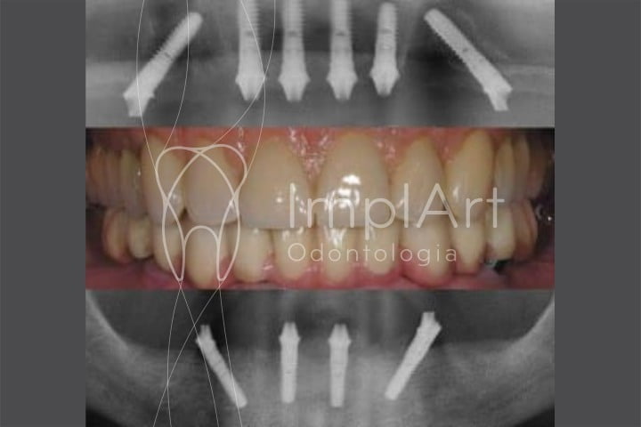 radiografia mostra distribuicao dos implantes dentarios na arcada dentaria e a protese dentaria fixa instalada