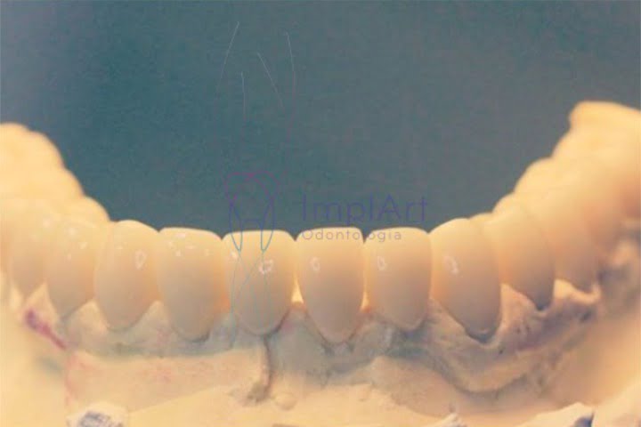 reabilitacao oral completa implante total