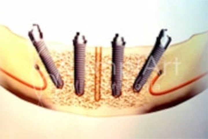 implantes posicionados 50kb