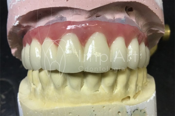 implante todos os dentes individuais