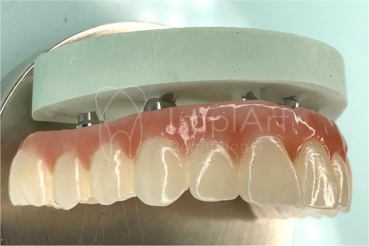 protese dentaria de zirconia total fixa em implantes