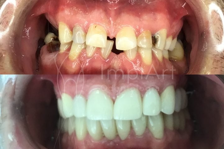 reabilitação oral funcional e estética com implantes dentários, coroas, lentes dentais, facetas