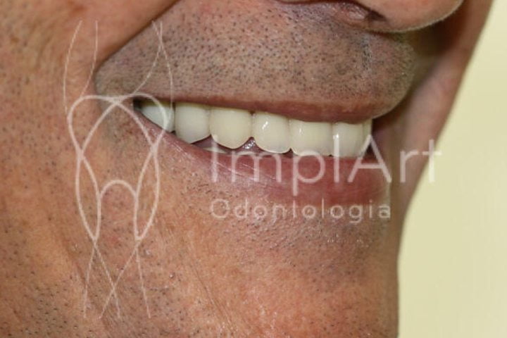Implante total superior: prótese dental protocolo Branemark