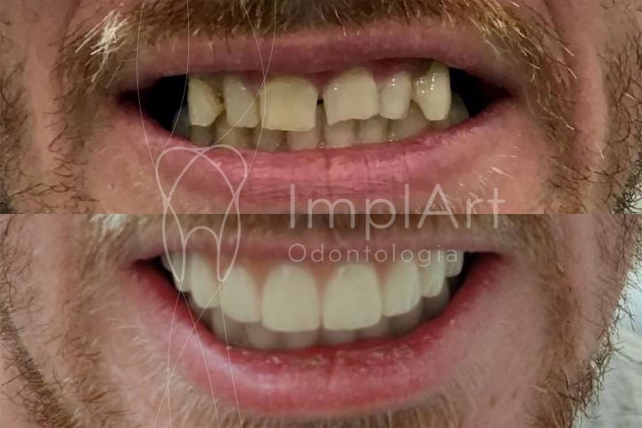 preço de um implante dentário