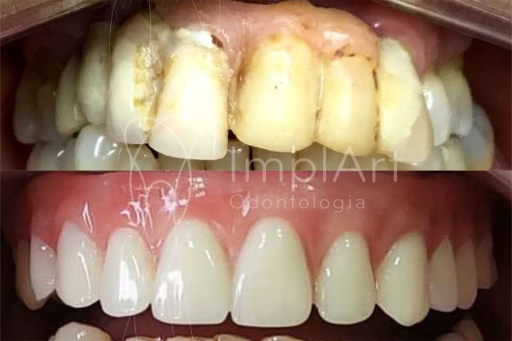 Reabilitação oral com implante superior e inferior
