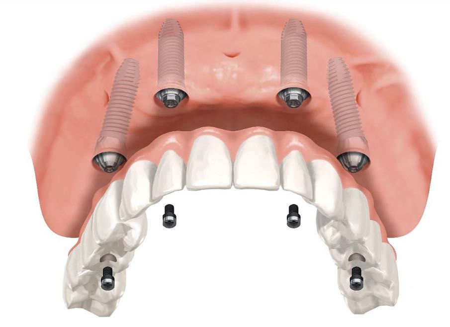 all on four quatro implantes dentários