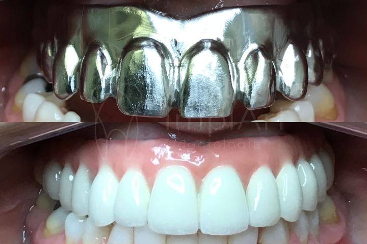 tipos de próteses protocolo dentarios