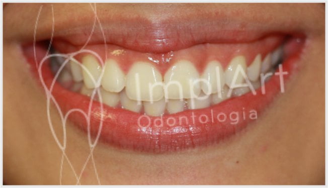Sorriso gengival – Estética dental com cirurgia plástica gengival
