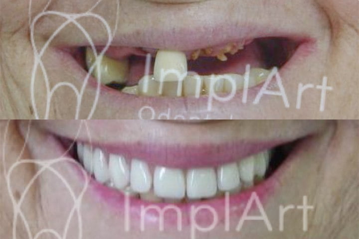implante dentário com carga imediata