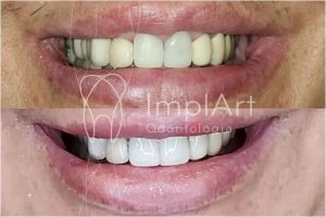 troca_coroas_dentes_da_frente_antes_e_depois_50kb 1 troca coroas dentes da frente antes e depois 50kb
