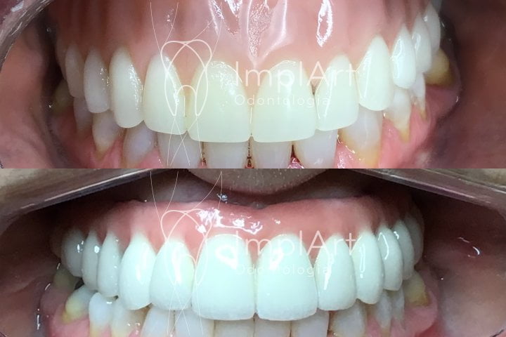 troca dentadura protese metaloceramica antes e depois 50kb