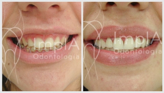 Fotos de tratamentos com estética dental e implantes dentais