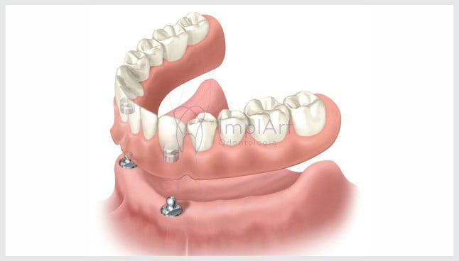 Vídeo – Overdenture | Prótese dental móvel sob implantes – Características