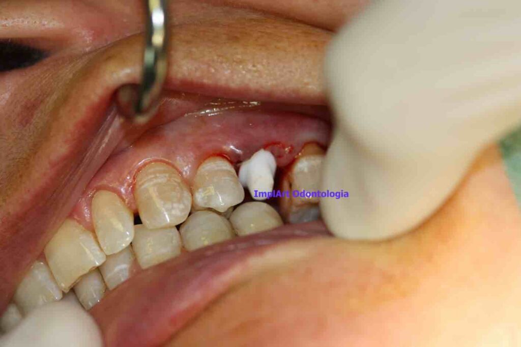 implante de zircônia em pré-molar