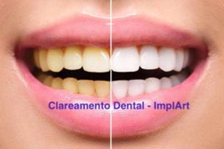 clareamento dental antes e depois 50kb