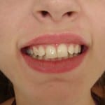 carga rápida implante dentario