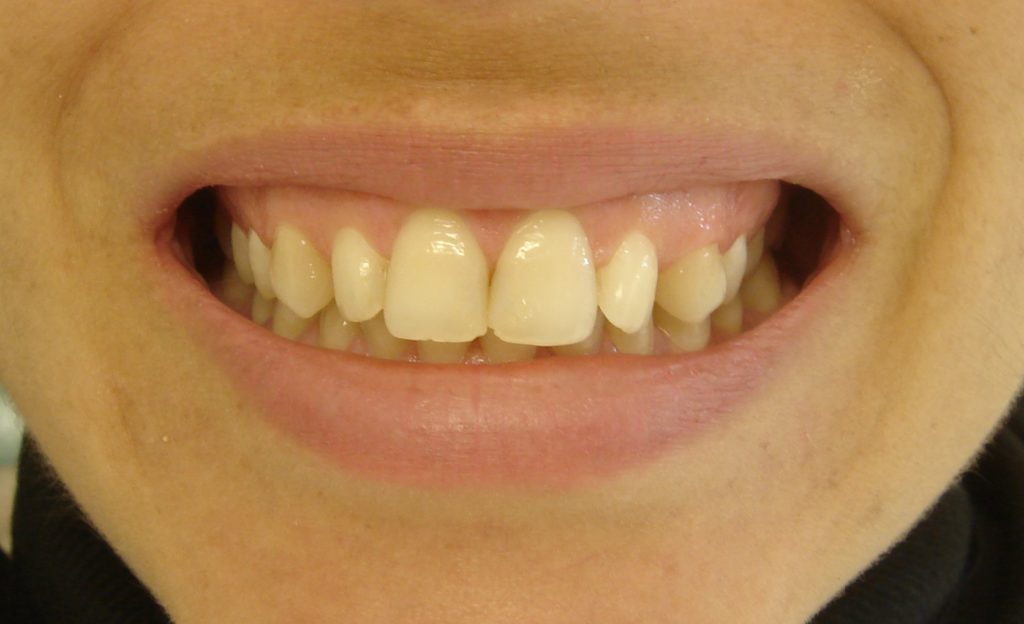 Agenesia dentária e a necessidade de implantes