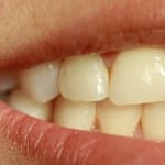 agenesia_dental