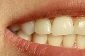 agenesia dental 1