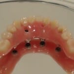 carga rápida com implante dentario