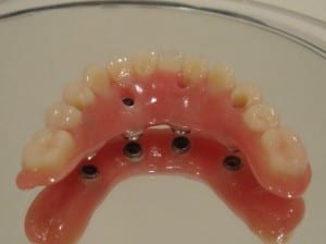 carga rápida com implante dentario